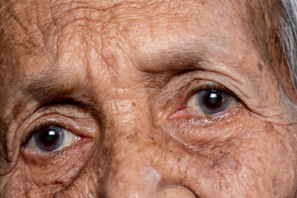 Close up of older persons eyes with a slightly worried expression