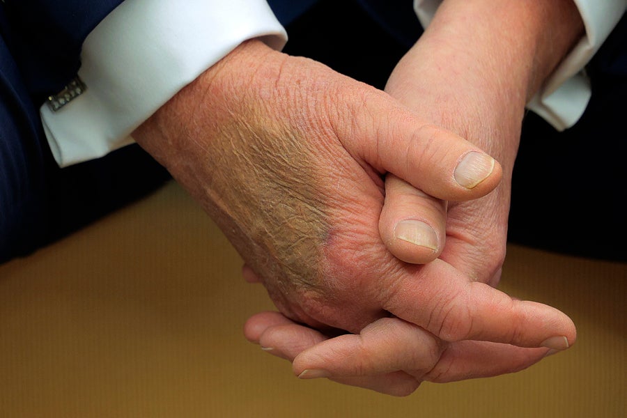 A close up of President Trump's hands clasped together with makeup covering a bruise on his right hand