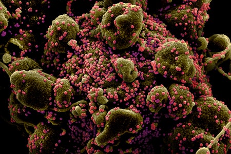 Colorized scanning electron micrograph of an apoptotic cell (greenish brown) heavily infected with SARS-COV-2 virus particles (pink), isolated from a patient sample