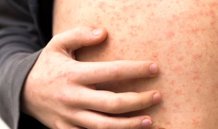 Sick child with red rash spots from measles.